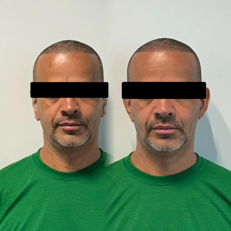Antes y después de un tratamiento en Salinova
