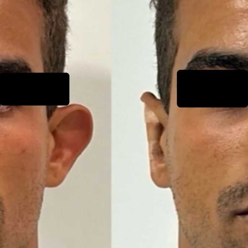 Antes y después de un tratamiento en Salinova