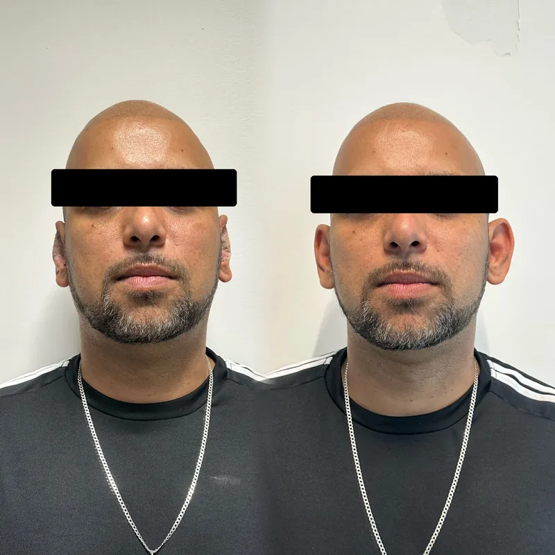 Antes y después de un tratamiento en Salinova